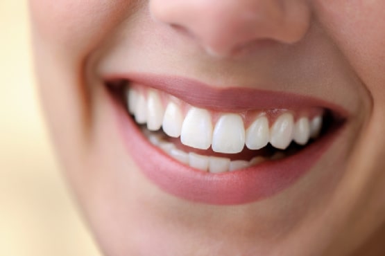 Dental Veneers in Chicago