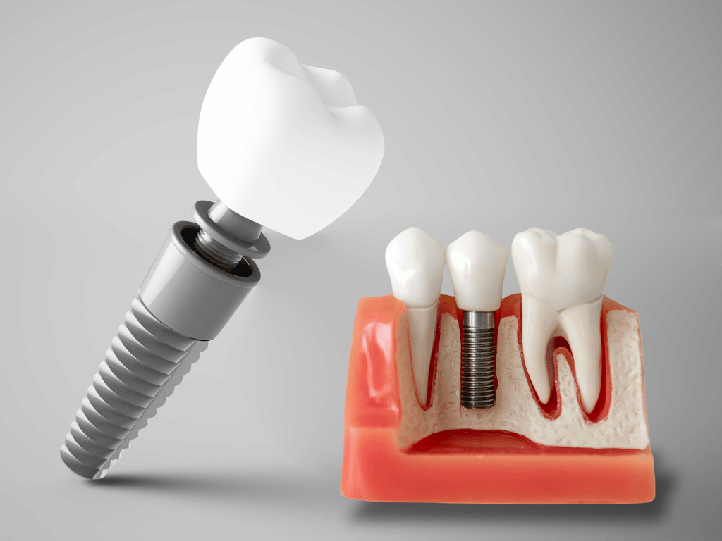Dental Implants Can Help Restore Your Smile