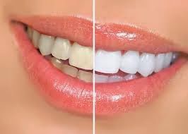 Laser Teeth Whitening Chicago