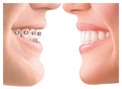 invisalign