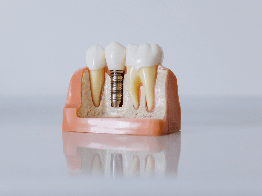 Dental Implants Work