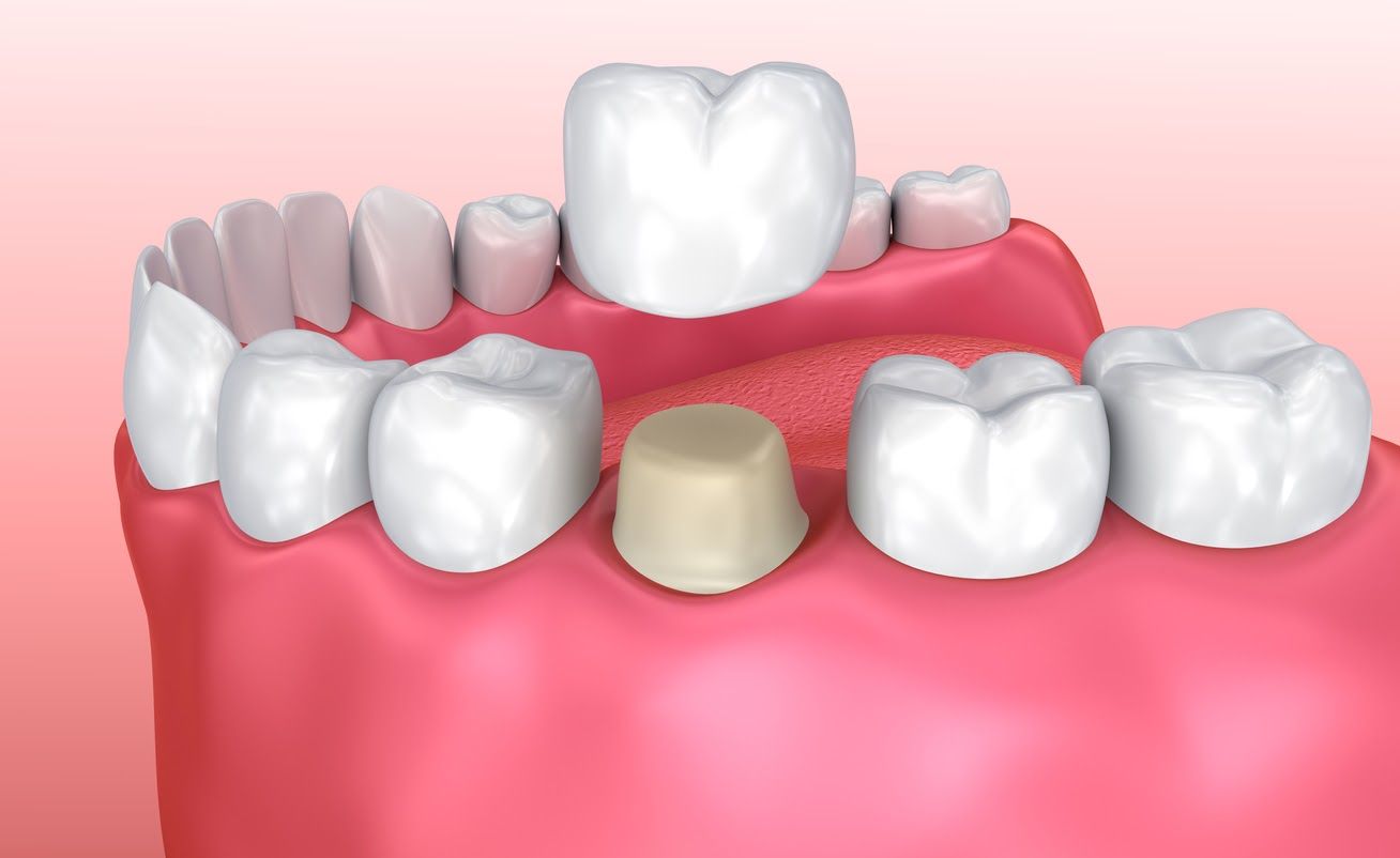 Dental Crown Vs Filling