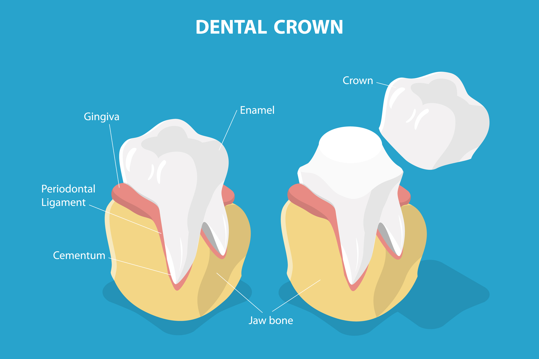 Diagram of dental crown