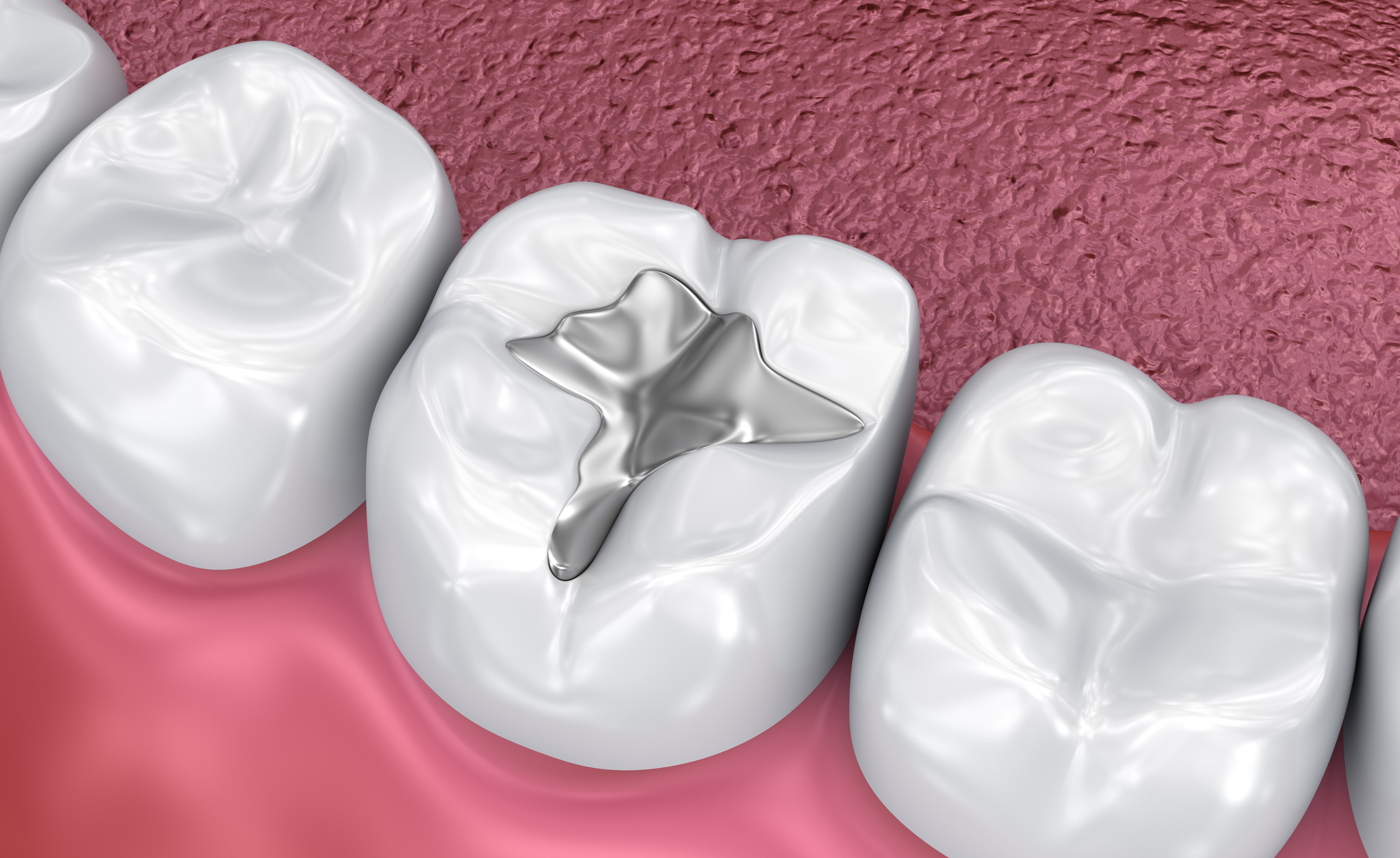 tooth filling illustration