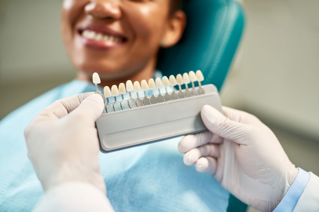 How Often Do Veneers Need to be Replaced?