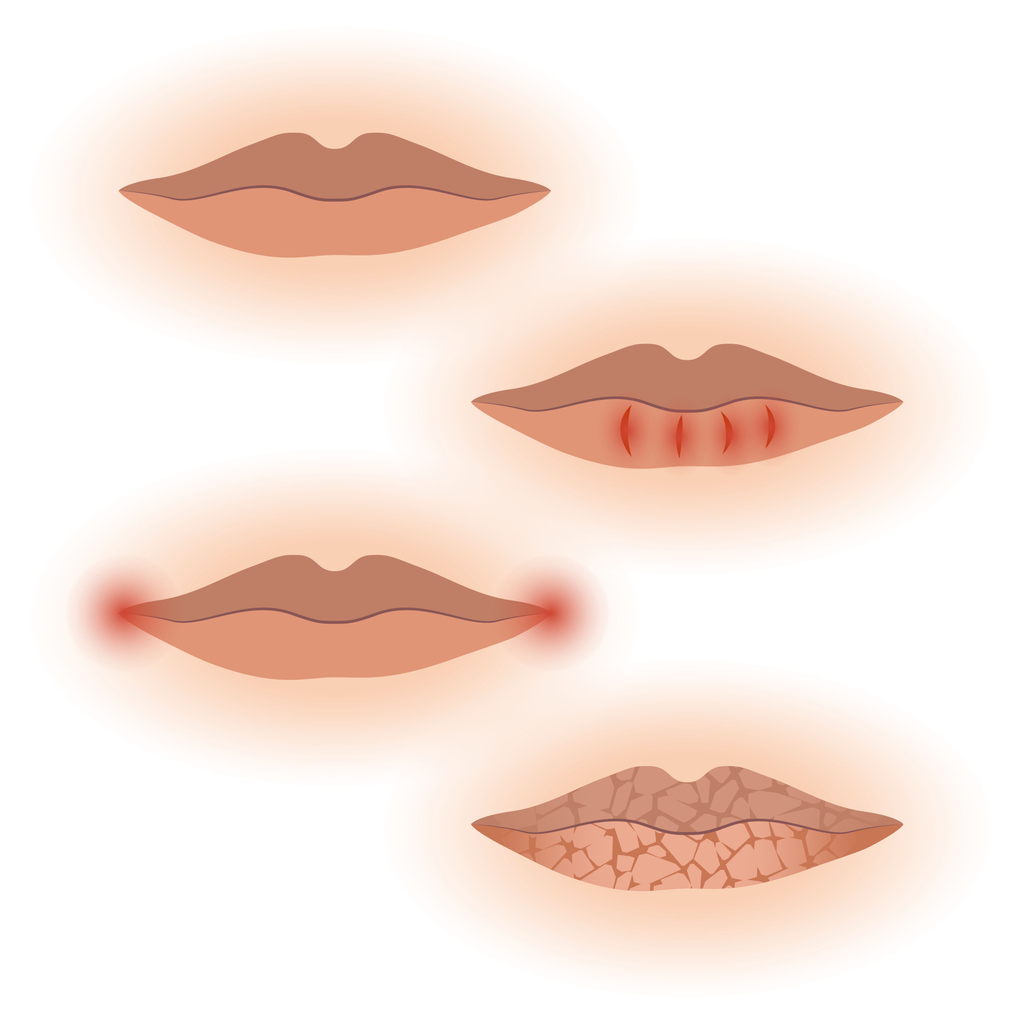 Images of dry mouth symptoms, including split lips, sores at corners of mouth, and cracked lips.