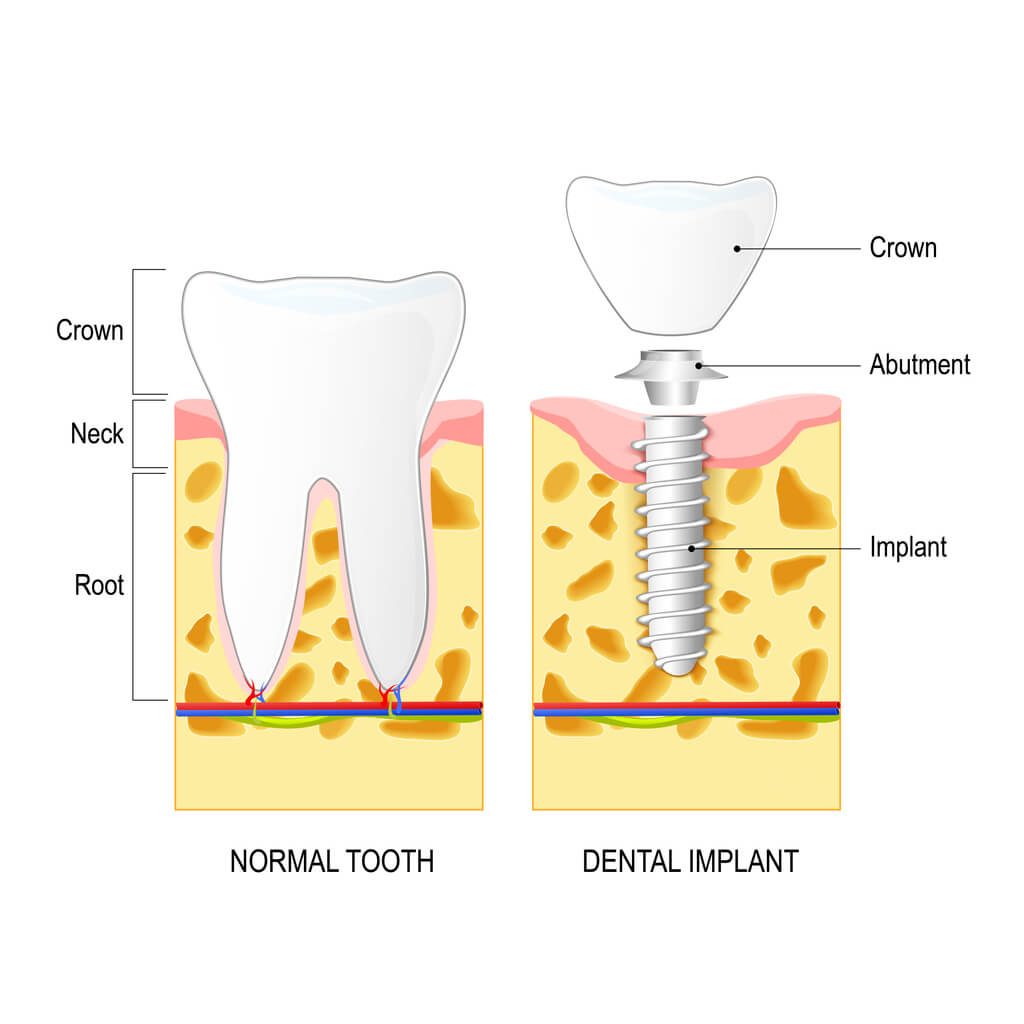 Dental Implants in South Loop