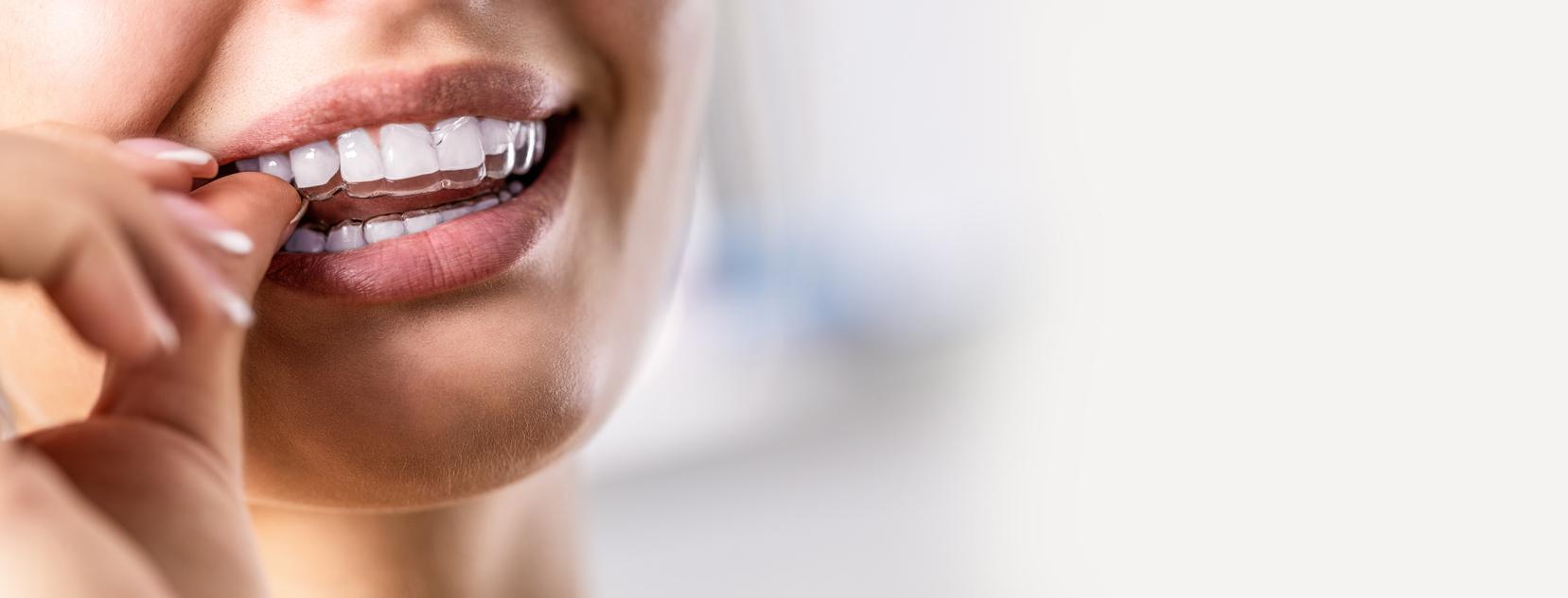 How Invisalign Works