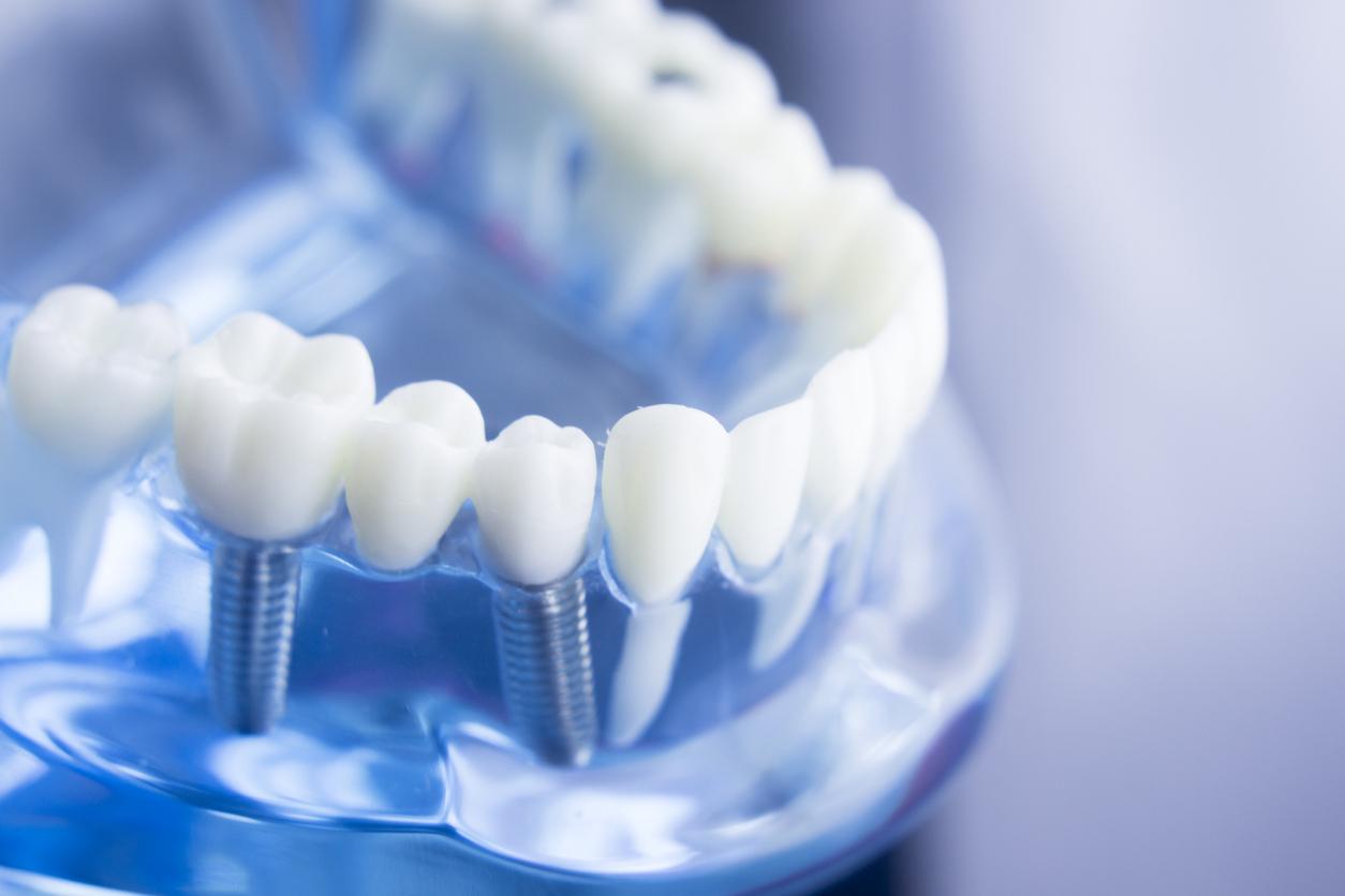 Translucent blue training implement shows how screws hold dental implants securely to the jaw bone