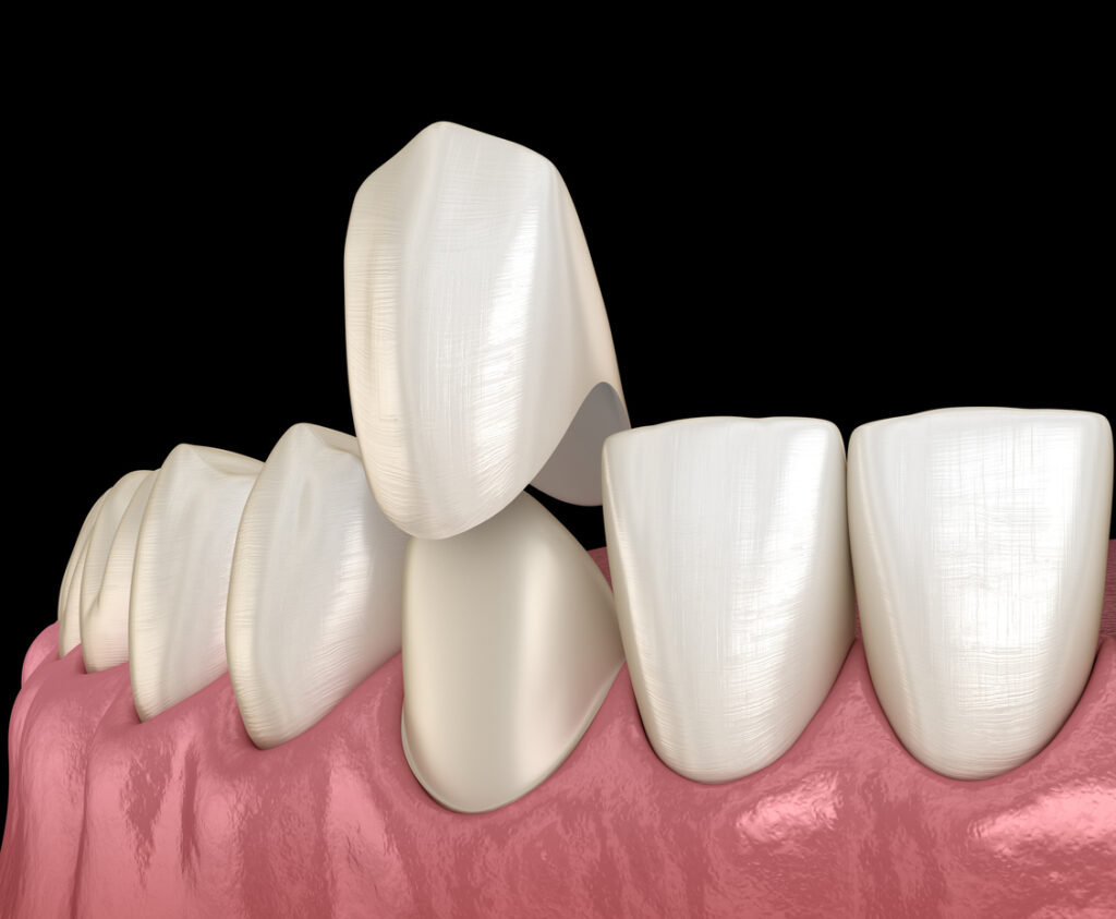 Image shows how thin veneer is fitted over natural tooth