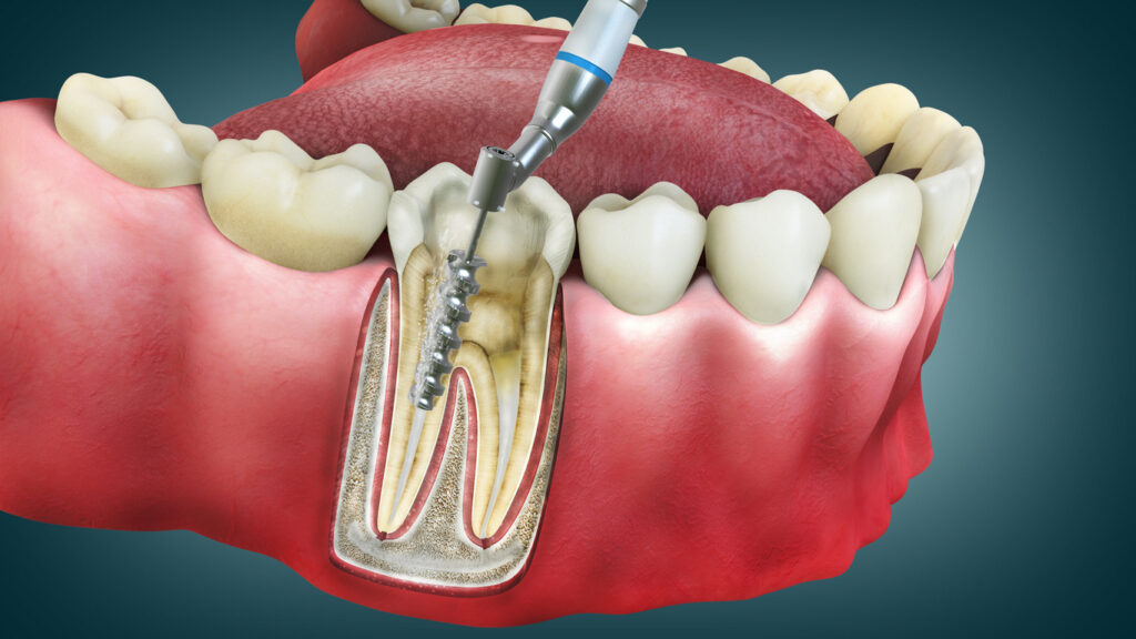 Root canal therapy Root canal therapy