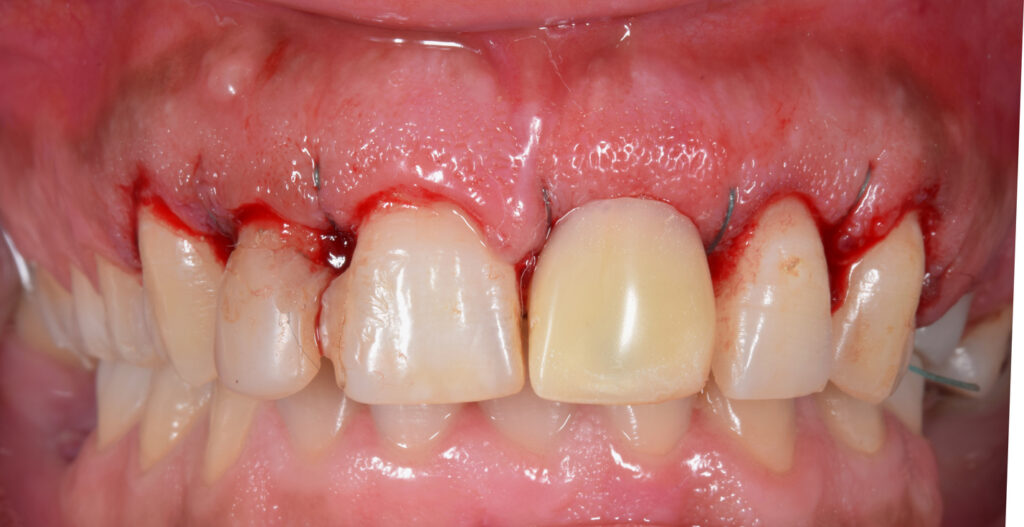 Gum Disease Prevention - Tips for Healthy Gums