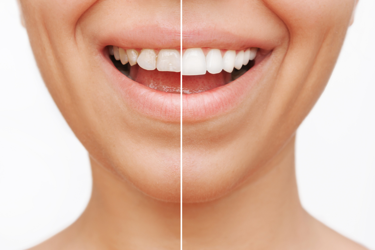 Side by side image of teeth with and without veneers.