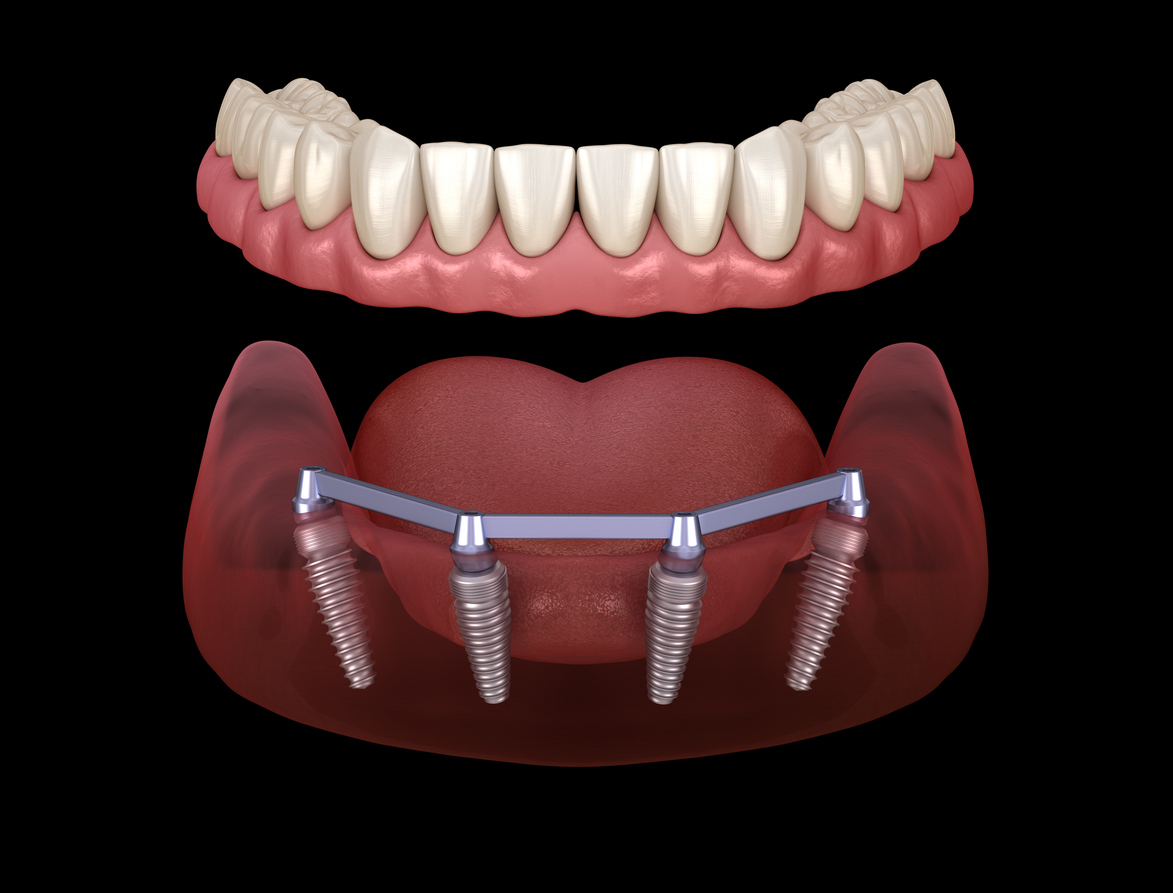 An image of an All on 4 Dental Implant of a lower set of teeth. In the image the implant posts are visible in the gum, while the artificial teeth are suspended in the image above the lower gums. 