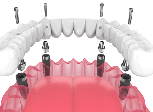 Dental Implant