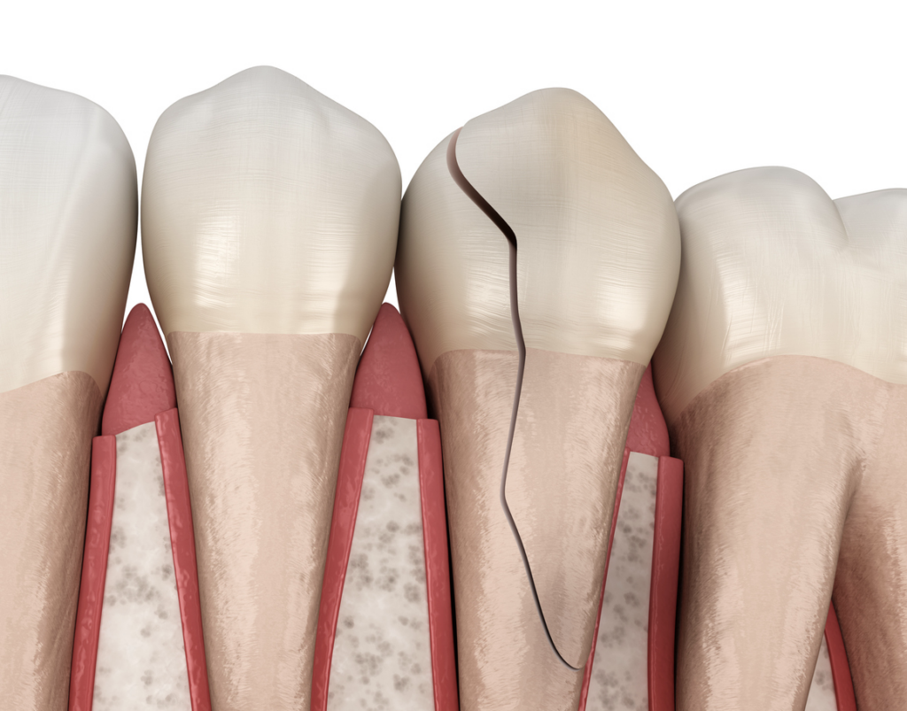 Four molars in the lower arch of teeth, one of which is badly cracked.