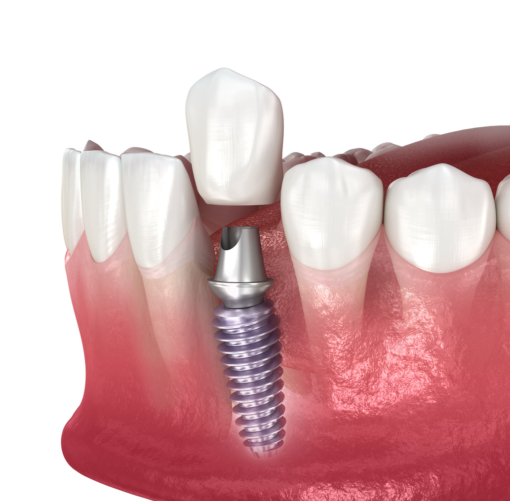 A dental implant and ceramic crown