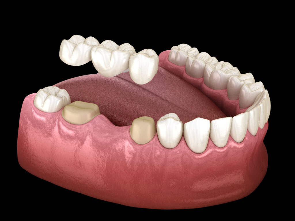 Dental bridge of 3 teeth over molar and premolar. Medically accurate 3D illustration of human teeth treatment