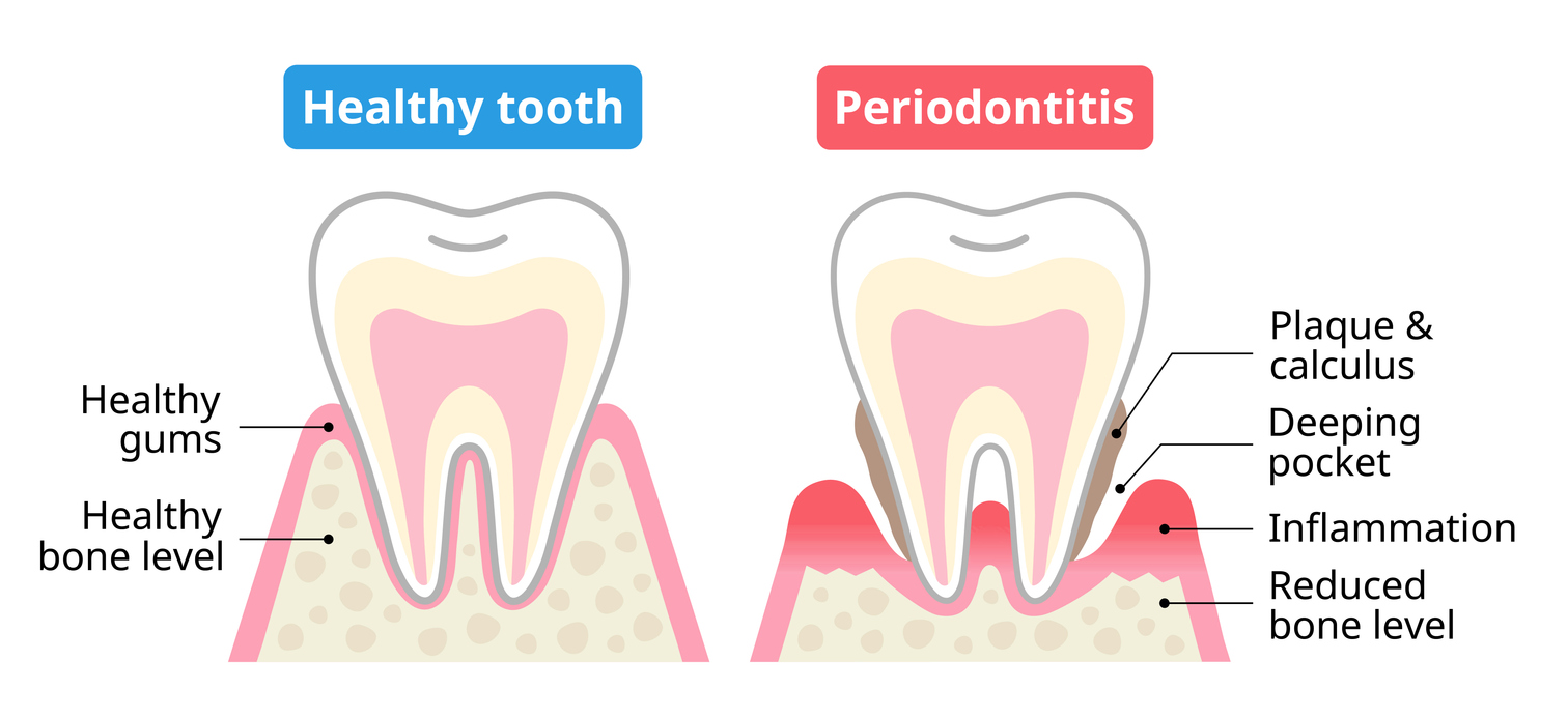 An illustration showing a healthy tooth and healthy gums on the left, and a tooth and gums affected by periodontitis on the right.