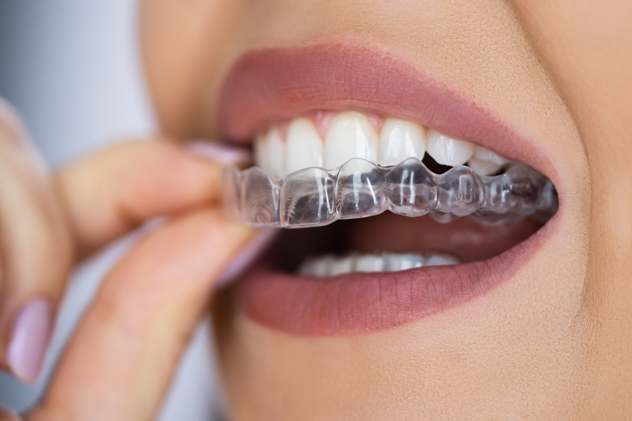 Woman wearing Invisalign for jaw alignment issue