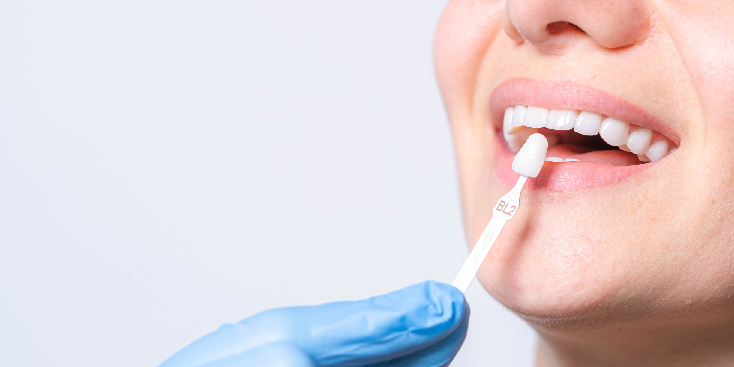 Woman receiving veneers and implants at the dentist
