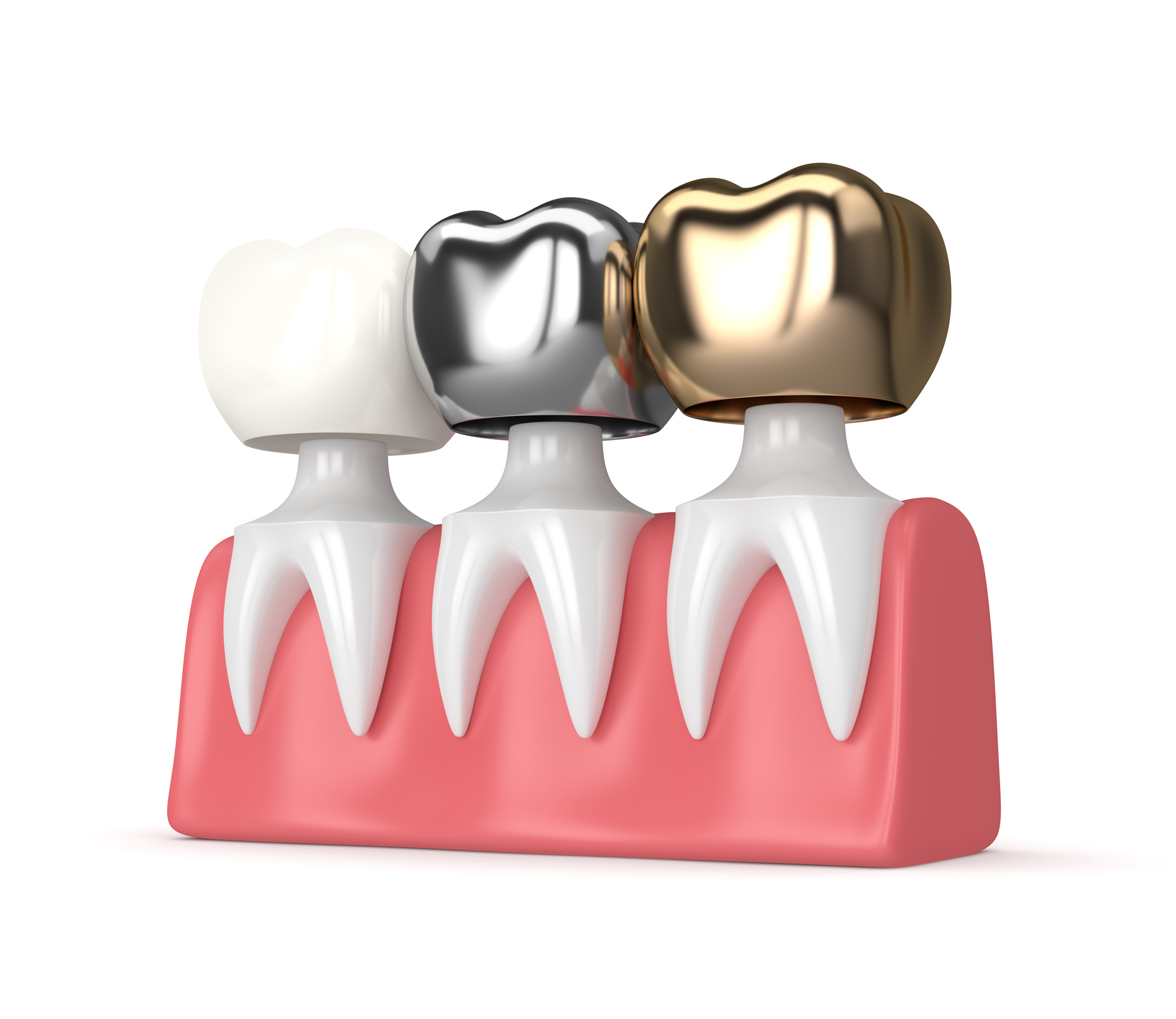 types of dental crowns illustration