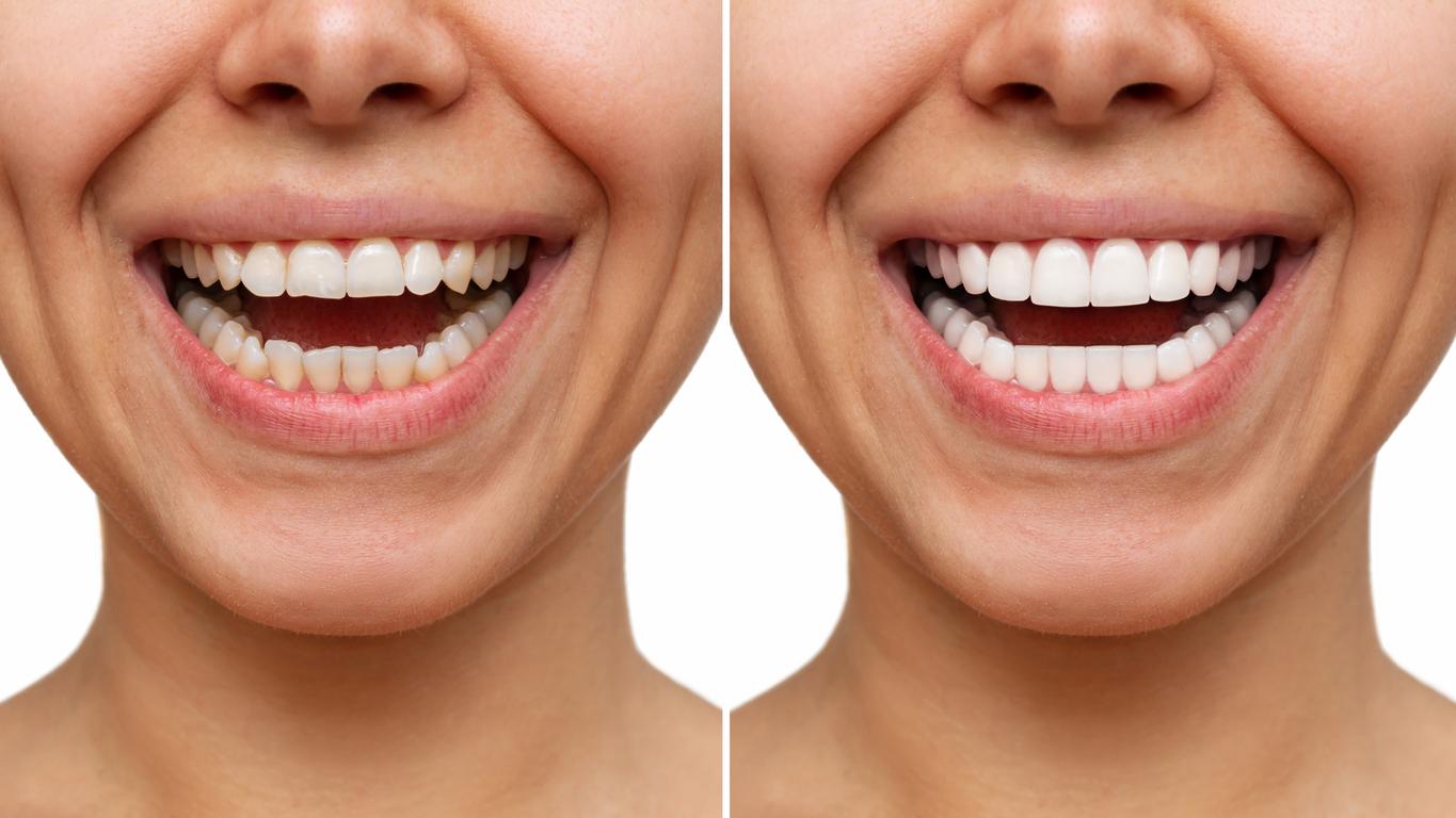 Veneers before and after images