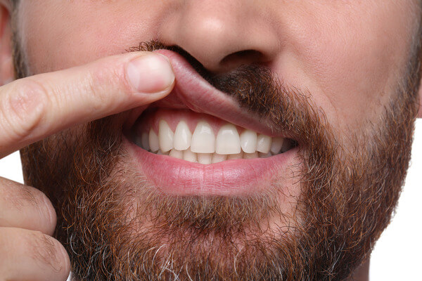 Man lifting up his lip to show his upper teeth and gum tissue