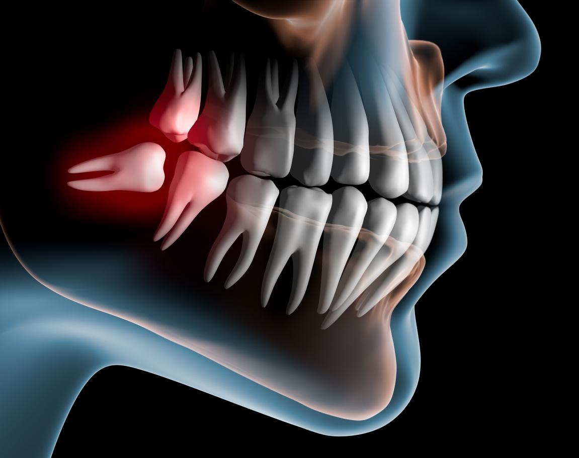 Digital image of teeth and a wisdom tooth shaded in red lying in the wrong position at the back of the mouth