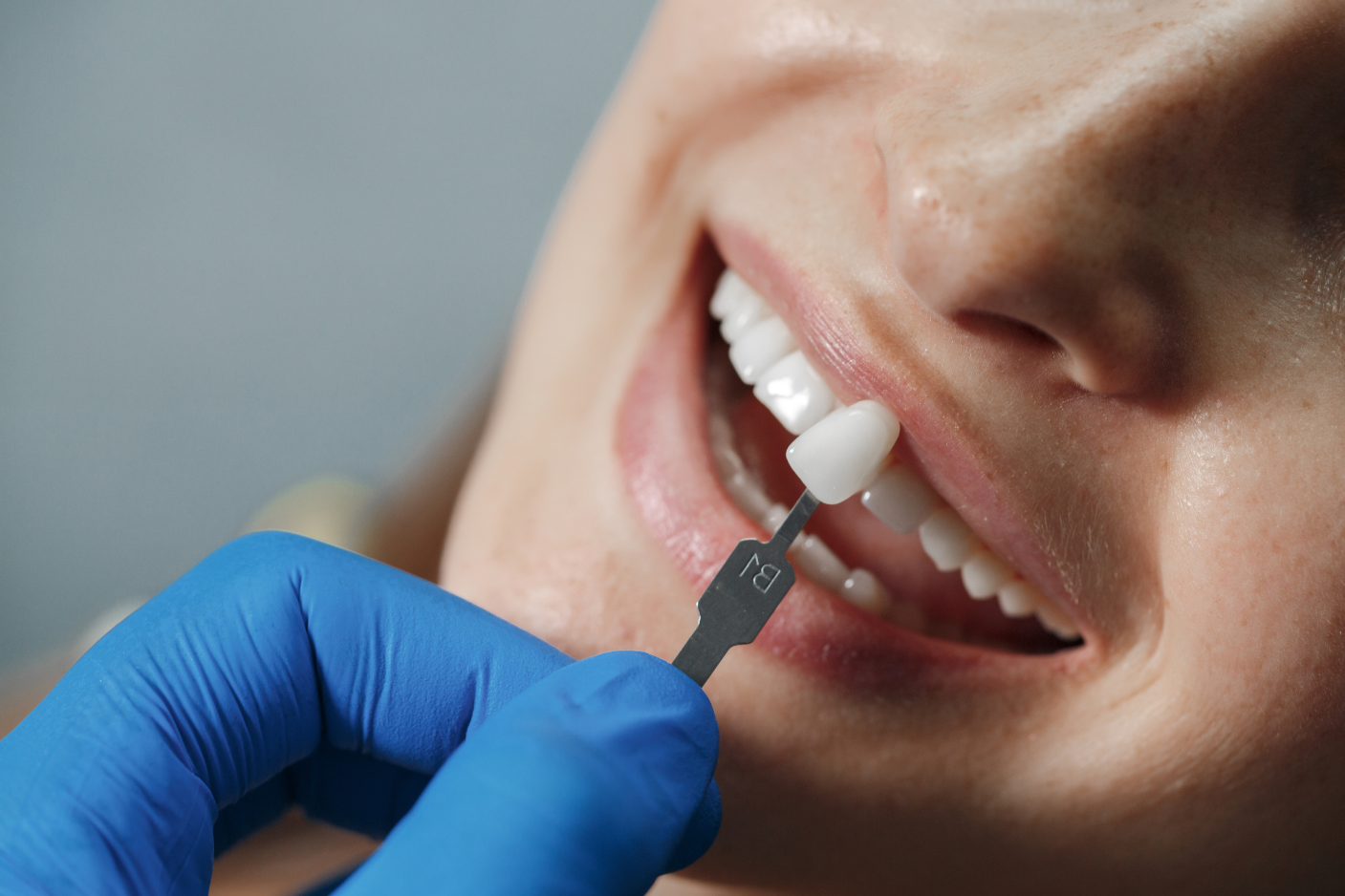 Close-up of a natural-looking porcelain dental crown smile at Art of Modern Dentistry Chicago