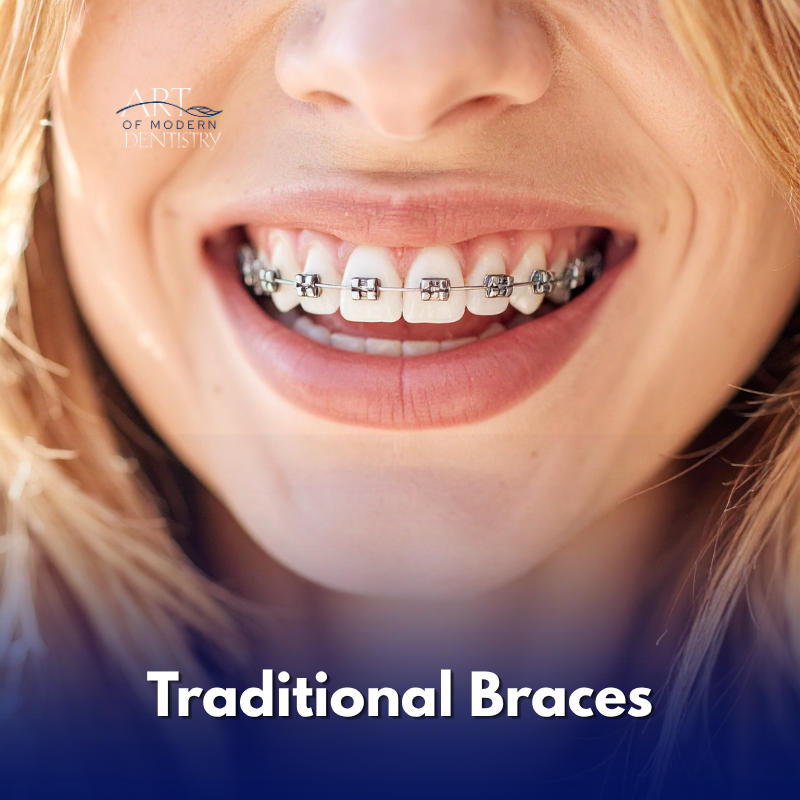 Traditional Braces