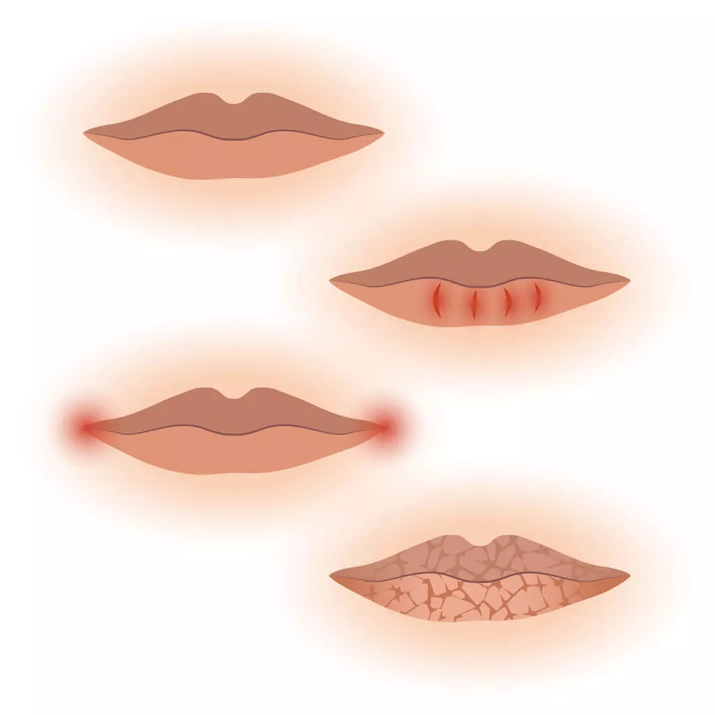 causes-of-xerostomia